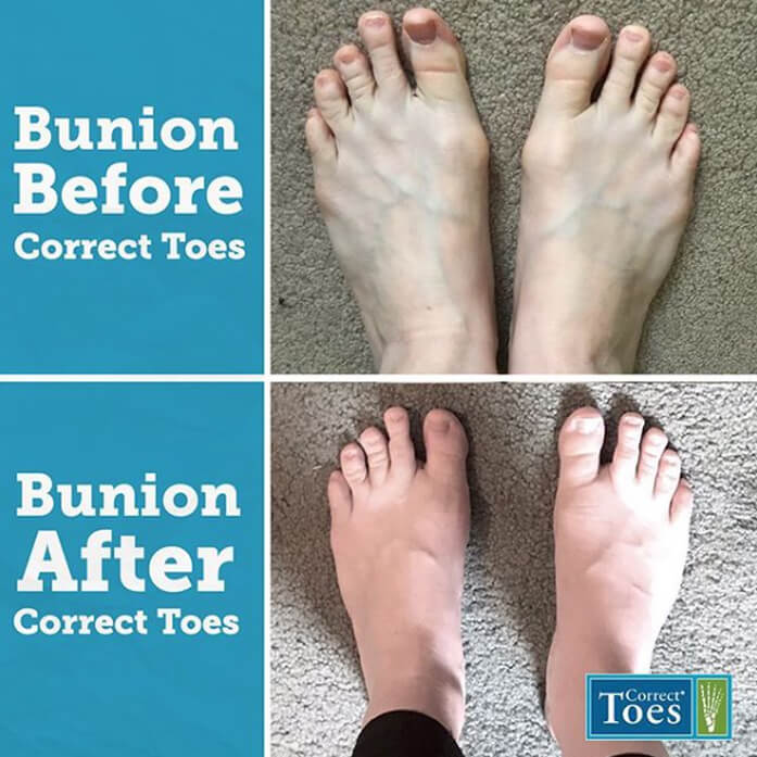 Before and After Toe Spacers